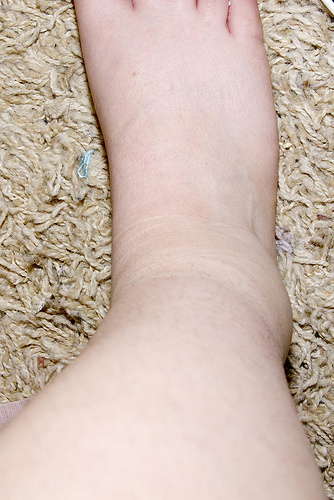 Edema of ankle
